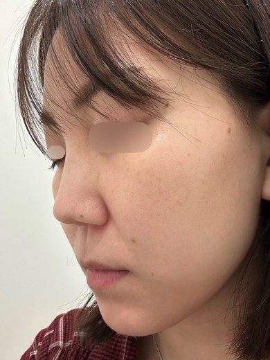 before photo: エレクトロポレーション