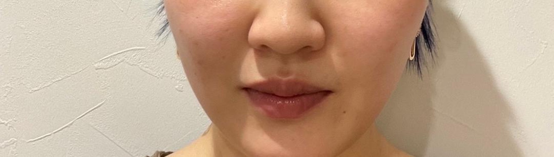 before photo: ほうれい線ヒアルロン酸