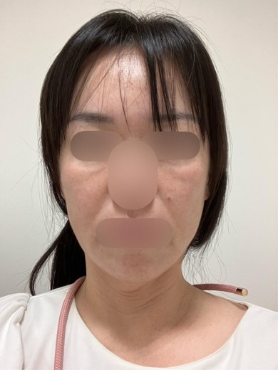 after photo: エクソソーム