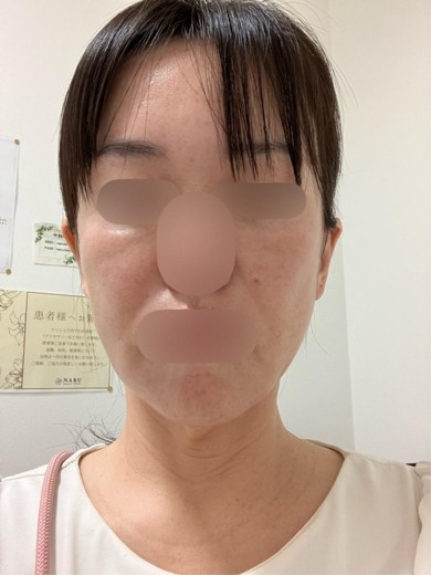 before photo: エクソソーム