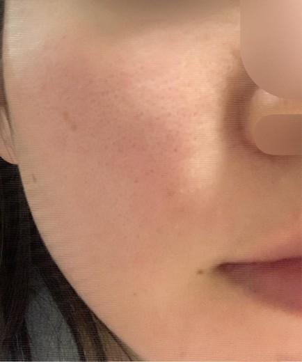 before photo: ピーリング