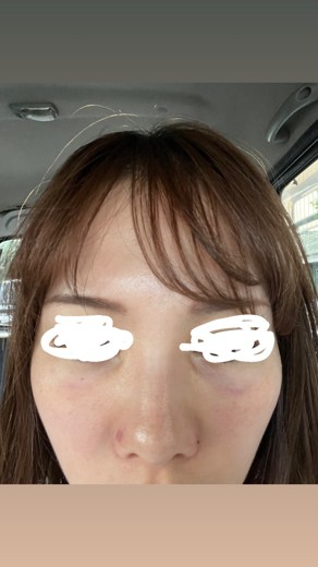 after photo: 脂肪溶解注射(顔)