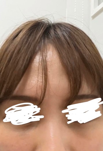 before photo: 脂肪溶解注射(顔)