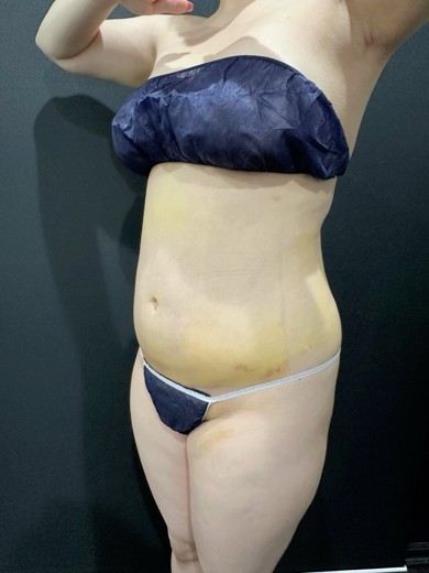 after photo: 脂肪吸引(ラブハンドル), 脂肪吸引(脇腹), 脂肪吸引(腹部)