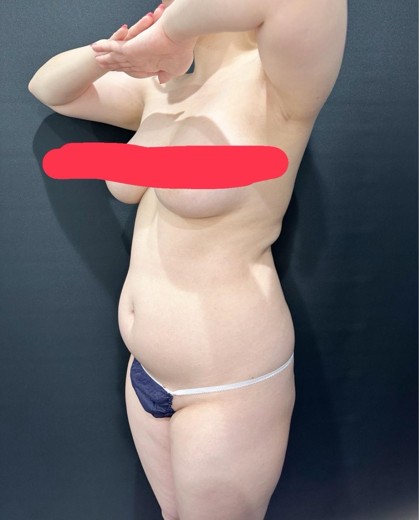before photo: 脂肪吸引(ラブハンドル), 脂肪吸引(脇腹), 脂肪吸引(腹部)