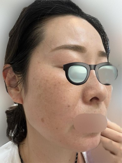 before photo: IPL(光/フォト治療)
