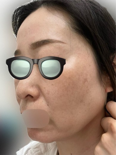 before photo: IPL(光/フォト治療)