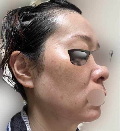 after photo: IPL(光/フォト治療)