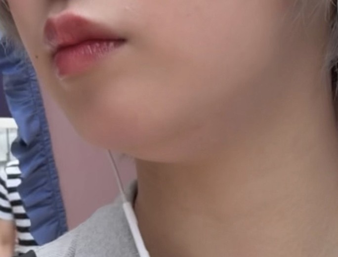 after photo: 脂肪溶解注射(顔)