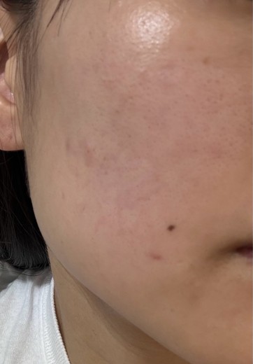 after photo: 診断・検査, マッサージピール(コラーゲンピール)