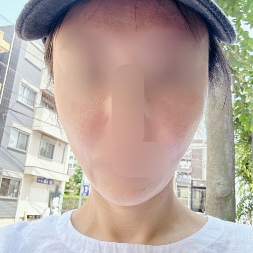 before photo: プラセンタ注射・点滴