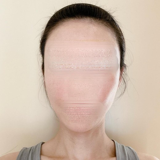 after photo: プラセンタ注射・点滴