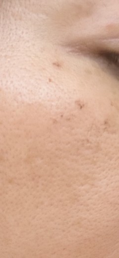 after photo: IPL(光/フォト治療), 診断・検査