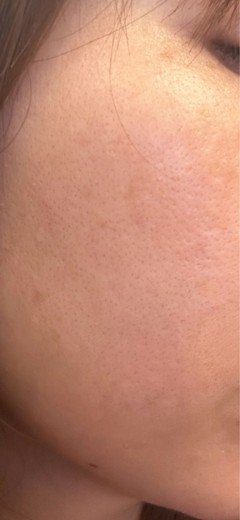 before photo: IPL(光/フォト治療), 診断・検査
