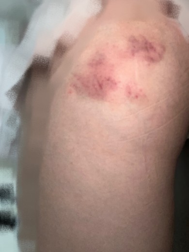 after photo: 脂肪溶解注射(太もも)