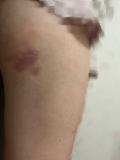 after photo: 脂肪溶解注射(太もも)