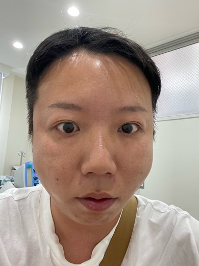 after photo: 糸リフト