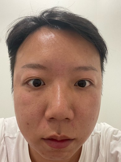 before photo: 糸リフト