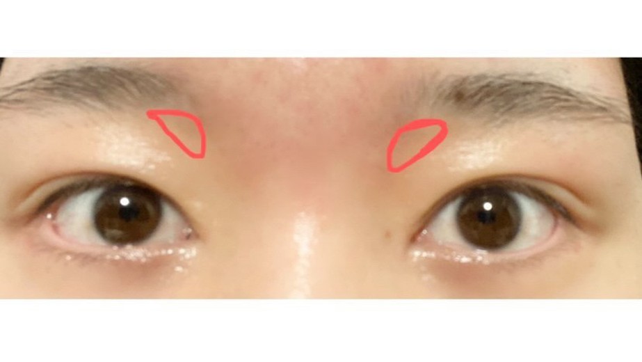 before photo: 目上切開