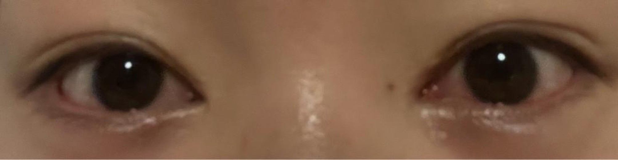 after photo: 目上切開