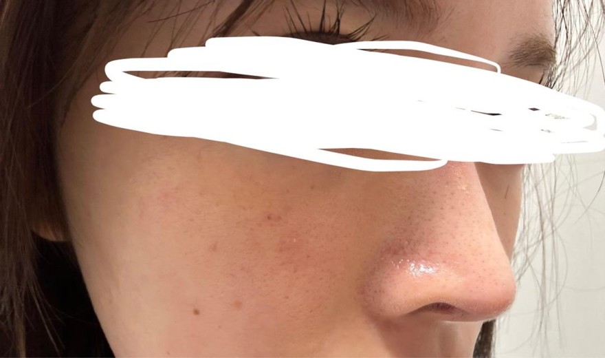 before photo: IPL(光/フォト治療), 診断・検査