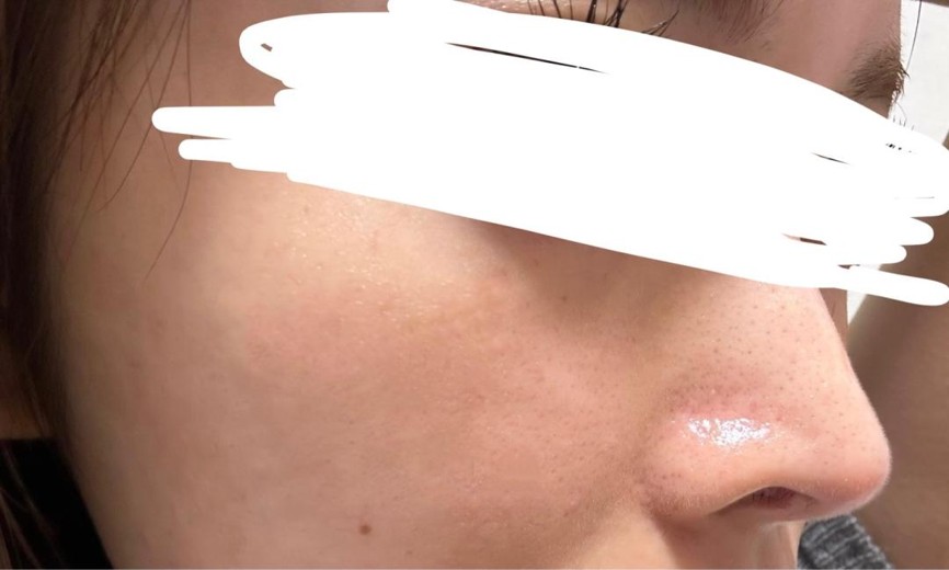 after photo: IPL(光/フォト治療), 診断・検査