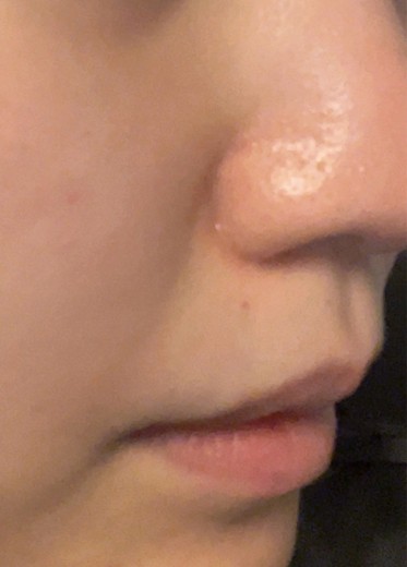 before photo: レーザーフェイシャル