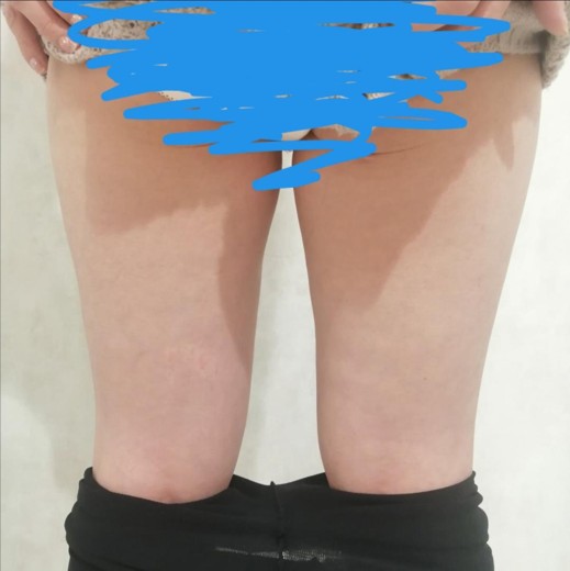 before photo: 脂肪冷却(太もも)
