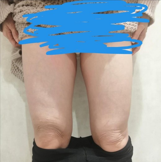 after photo: 脂肪冷却(太もも)
