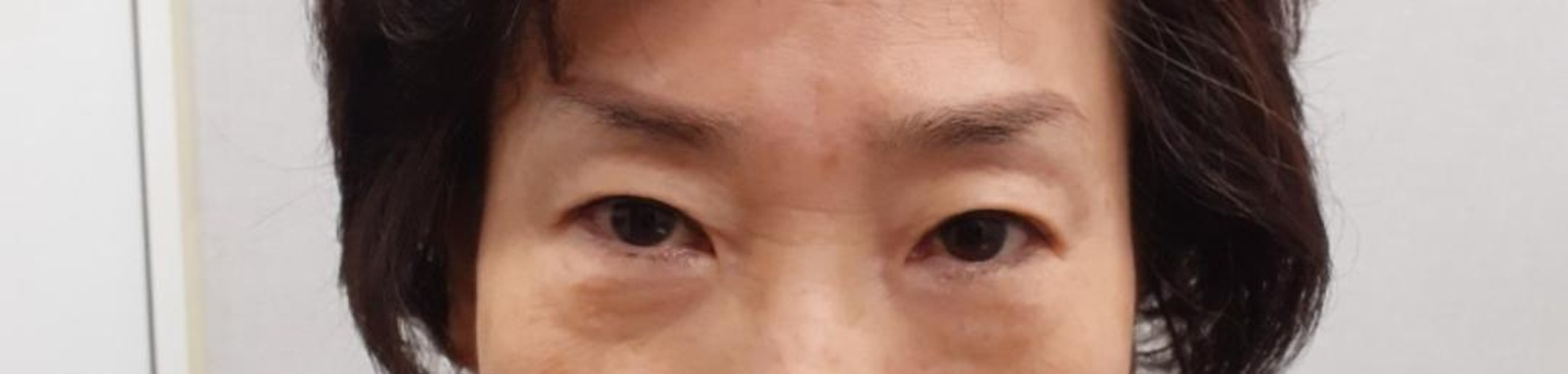 before photo: 하안검성형