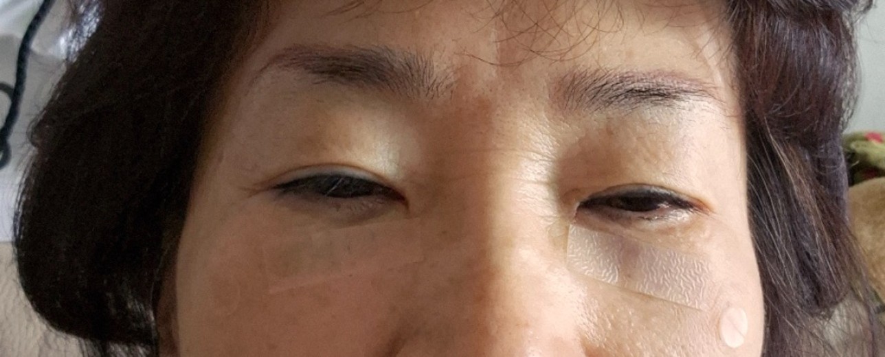 after photo: 하안검성형