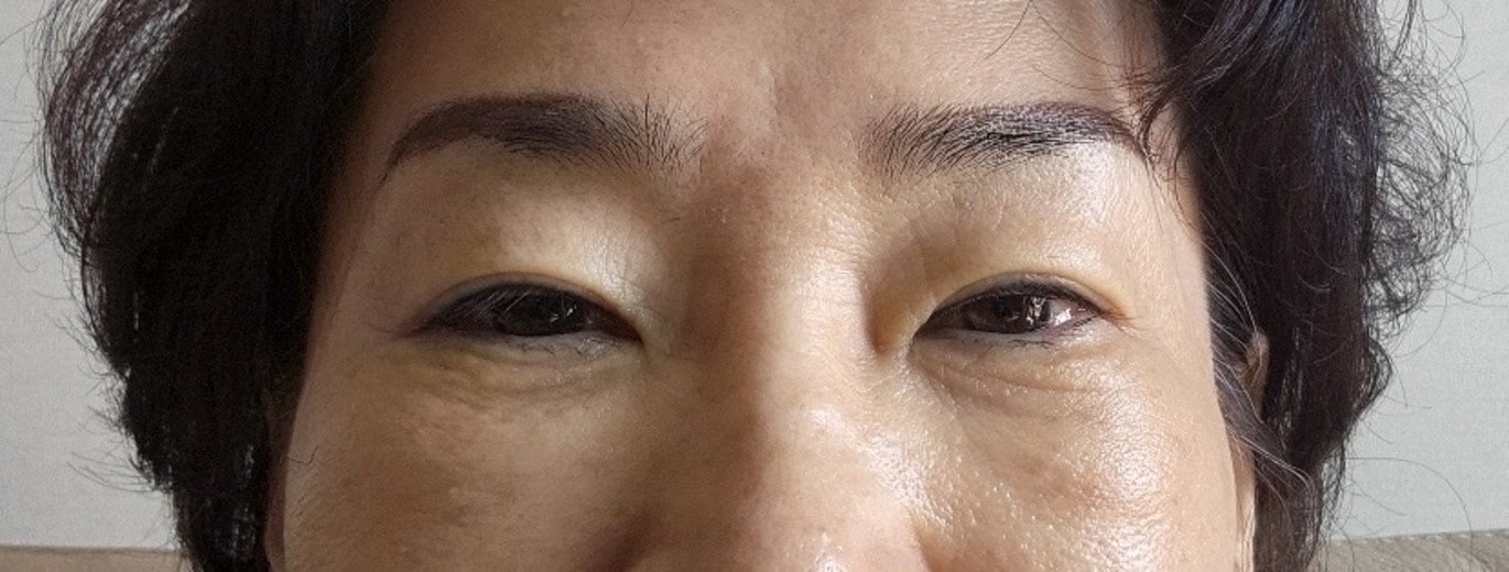 after photo: 하안검성형