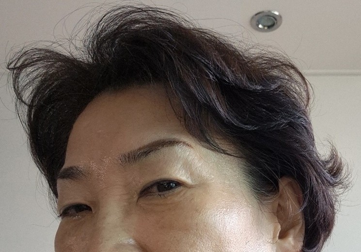 after photo: 하안검성형