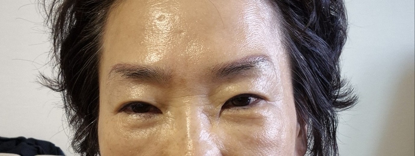 after photo: 하안검성형