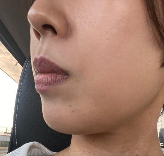 before photo: あごヒアルロン酸, こめかみヒアルロン酸