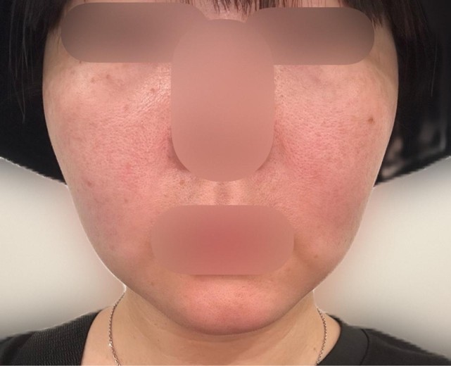 before photo: マッサージピール(コラーゲンピール)