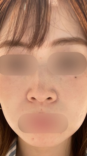 before photo: リジュランヒーラー, ダーマペン