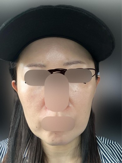 before photo: 水光注射