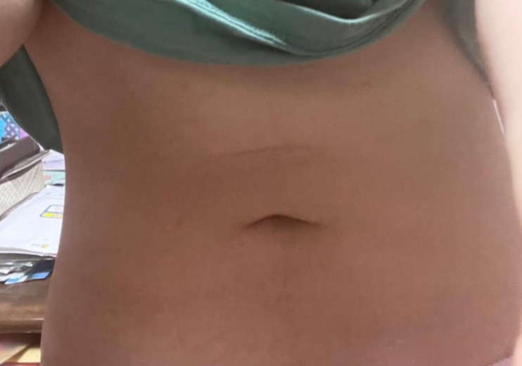 after photo: 脂肪吸引(腹部)