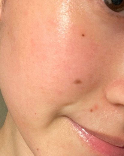 before photo: IPL(光/フォト治療), 診断・検査