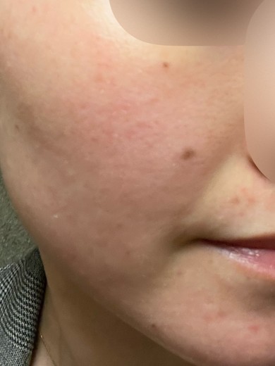 after photo: IPL(光/フォト治療), 診断・検査