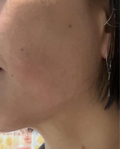 after photo: ダブロ(ハイフ)