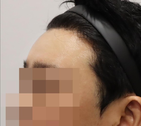 after photo: 이마필러