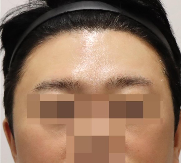 after photo: 이마필러