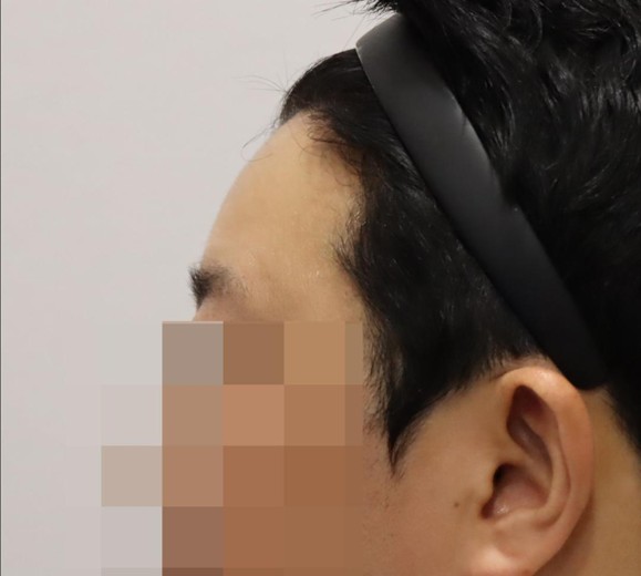 after photo: 이마필러