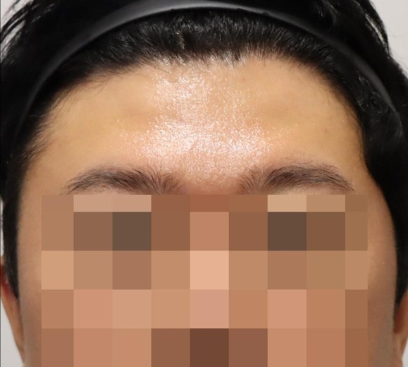 before photo: 이마필러