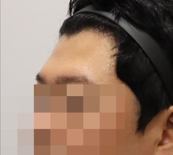 before photo: 이마필러