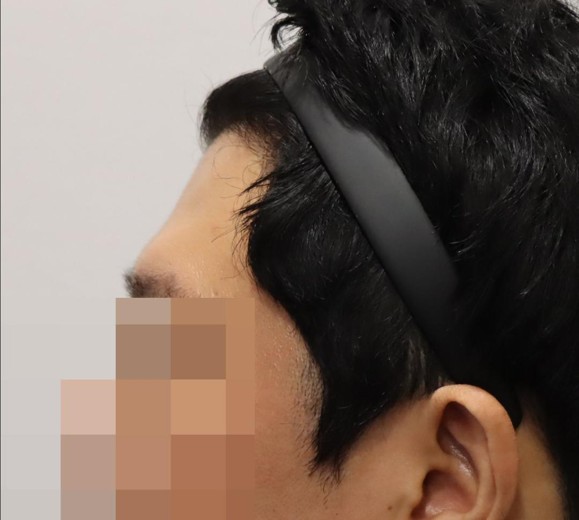 before photo: 이마필러