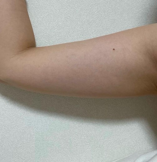 before photo: 脂肪冷却(腕)