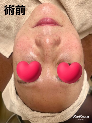 before photo: ヴェルベットスキン